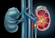 Types of Kidney Stones